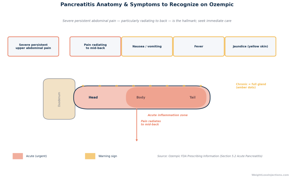 Anatomical diagram of the pancreas showing acute inflammation zones (red) and chronic zones (orange), with overlaid symptom icons indicating pain radiating to back, nausea, vomiting, fever, and jaundice, sourced from the Ozempic FDA prescribing information